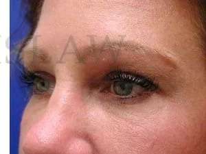 Tear Trough Filler Before & After Patient #1454