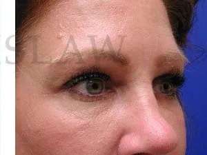 Tear Trough Filler Before & After Patient #1454