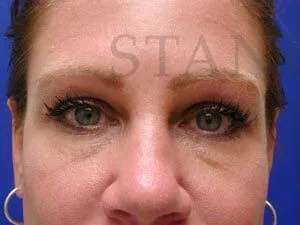 Tear Trough Filler Before & After Patient #1454