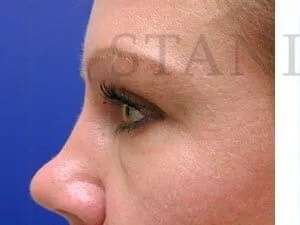 Tear Trough Filler Before & After Patient #1454