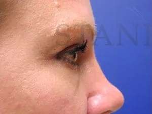 Tear Trough Filler Before & After Patient #1454