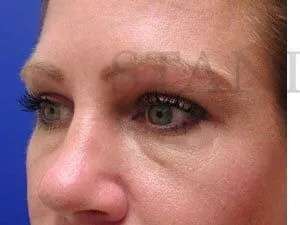 Tear Trough Filler Before & After Patient #1454