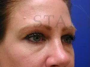 Tear Trough Filler Before & After Patient #1454