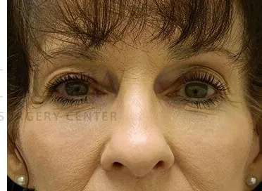 Tear Trough Filler Before & After Patient #1443