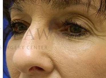 Tear Trough Filler Before & After Patient #1443