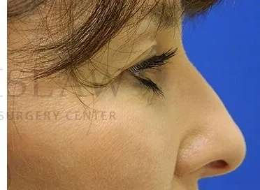 Tear Trough Filler Before & After Patient #1443