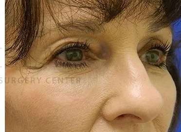 Tear Trough Filler Before & After Patient #1443