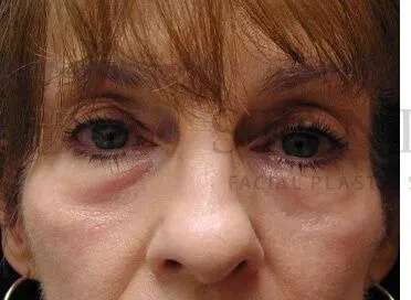 Tear Trough Filler Before & After Patient #1443