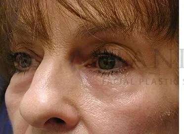 Tear Trough Filler Before & After Patient #1443