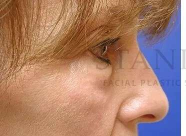 Tear Trough Filler Before & After Patient #1443
