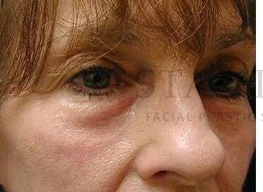 Tear Trough Filler Before & After Patient #1443