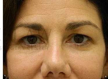 Tear Trough Filler Before & After Patient #1434