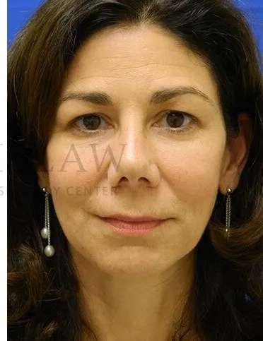 Tear Trough Filler Before & After Patient #1434
