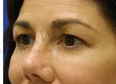 Tear Trough Filler Before & After Patient #1434