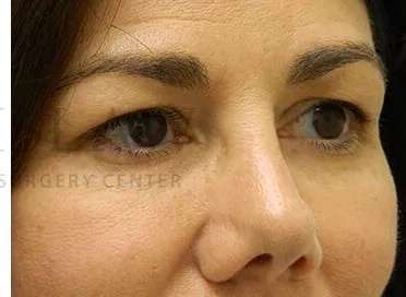 Tear Trough Filler Before & After Patient #1434