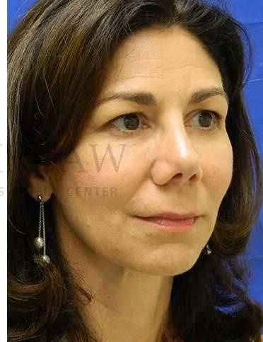 Tear Trough Filler Before & After Patient #1434