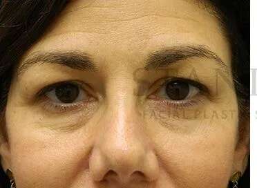 Tear Trough Filler Before & After Patient #1434