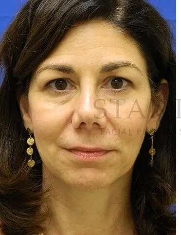 Tear Trough Filler Before & After Patient #1434