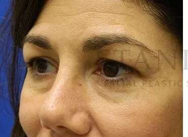 Tear Trough Filler Before & After Patient #1434