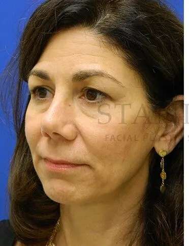 Tear Trough Filler Before & After Patient #1434