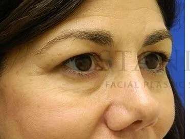Tear Trough Filler Before & After Patient #1434