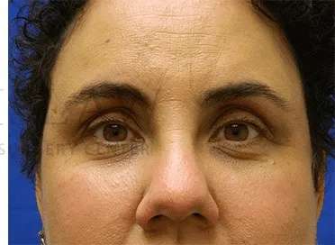 Tear Trough Filler Before & After Patient #1421