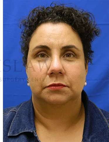 Tear Trough Filler Before & After Patient #1421
