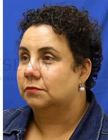 Tear Trough Filler Before & After Patient #1421