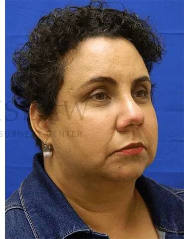 Tear Trough Filler Before & After Patient #1421