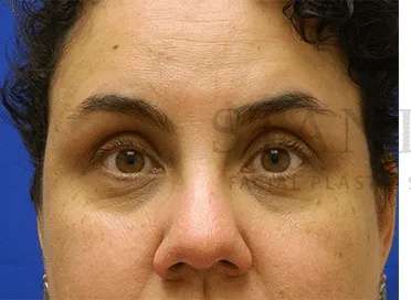 Tear Trough Filler Before & After Patient #1421