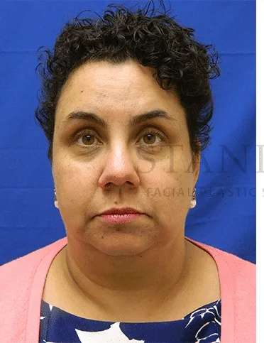 Tear Trough Filler Before & After Patient #1421