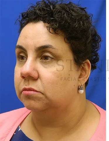Tear Trough Filler Before & After Patient #1421