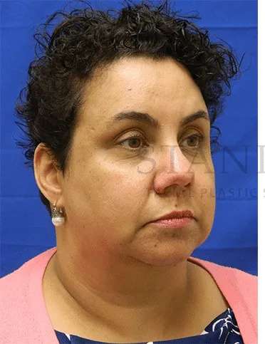 Tear Trough Filler Before & After Patient #1421