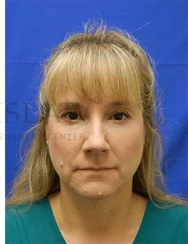 Tear Trough Filler Before & After Patient #1412