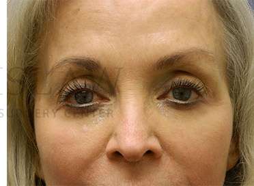 Tear Trough Filler Before & After Patient #1409
