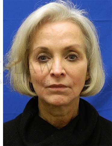 Tear Trough Filler Before & After Patient #1409