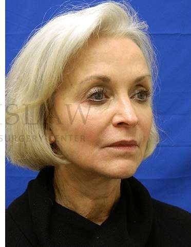 Tear Trough Filler Before & After Patient #1409