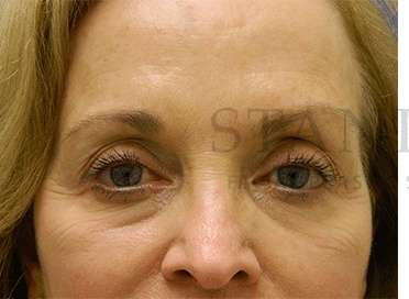 Tear Trough Filler Before & After Patient #1409