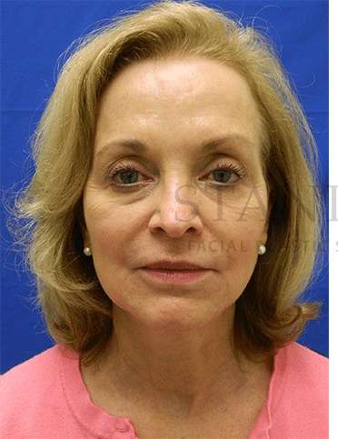 Tear Trough Filler Before & After Patient #1409