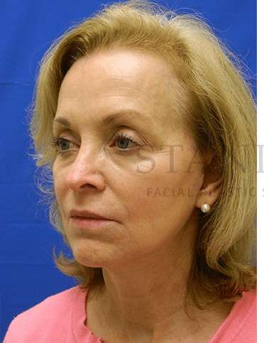 Tear Trough Filler Before & After Patient #1409
