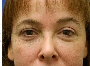 Tear Trough Filler Before & After Patient #1400