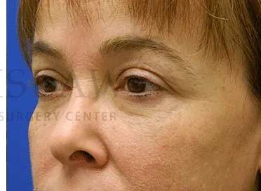 Tear Trough Filler Before & After Patient #1400