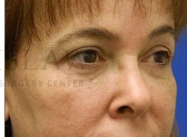 Tear Trough Filler Before & After Patient #1400