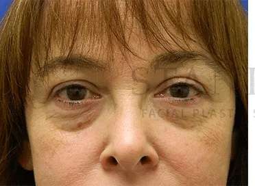 Tear Trough Filler Before & After Patient #1400