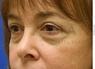 Tear Trough Filler Before & After Patient #1400