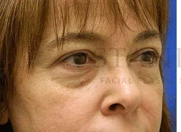 Tear Trough Filler Before & After Patient #1400