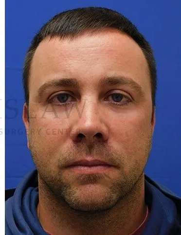Tear Trough Filler Before & After Patient #1393