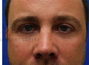 Tear Trough Filler Before & After Patient #1393