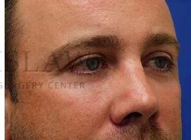 Tear Trough Filler Before & After Patient #1393