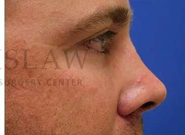 Tear Trough Filler Before & After Patient #1393